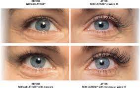 See full list on wikihow.com Latisse In Reno Sparks Hidden Valley Nv Reno Nv Janiga Mds