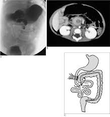 Image result for Midgut Volvulus