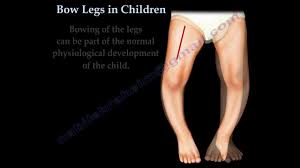 Image result for Pediatric Leg Disorder