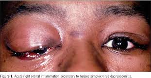 Image result for Dacryoadenitis