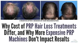 What are prp injections and how do they work? Factors Of Differing Costs Of Prp Hair Loss Treatments And Why Expensive Prp Machines Are Unproven Youtube