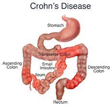 Crohn S Disease Questions Diagram Quizlet
