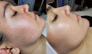 Booked in for a skin consult with rachael as my skin has felt sensitive and irritated lately. Medspa Services Skin By Kay Leigh