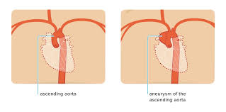 Ascending Aortic Aneurysm Repair Surgery And Size Criteria