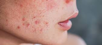 Image result for acne face