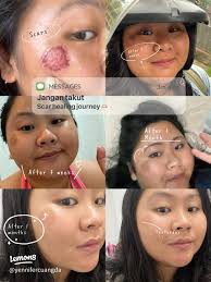 Mengucapkan Selamat Tinggal kepada Parut yang Menyakitkan