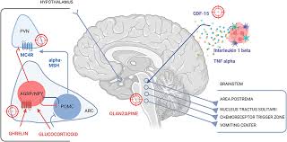 Image result for Cachexia in Cancer