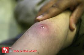 Skin Abscesses: Preventive Measures And Treatments - Walkin Clinic