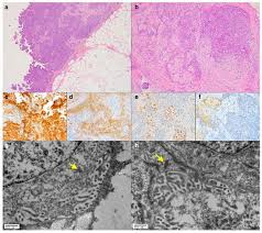 (mcd) was confirmed by electron microscopy in the renal biopsy. Diagnostics Free Full Text Diagnostic Challenges In Epithelioid Pleural Mesothelioma Case Series With Support From Electron Microscopy Html