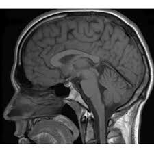 Mri Cancerquest