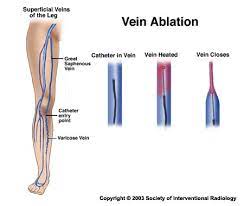 Endovenous Laser Or Radiofrequency Vein Ablation Northwestern Medicine