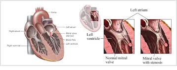 Mitral stenosis with marked thickening of the leaflets and left atrial hypertrophy. What Is Mitral Valve Stenosis Mvp Resource