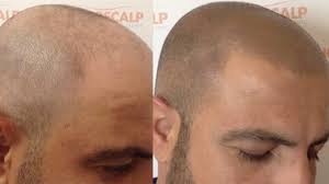 If you are looking for a partial hairline tattoo that. Scalp Micropigmentation Clinic Hair Tattoo Sydney Novoscalp