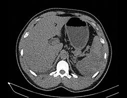 Considerado enfarte esplénico cardioembólico, por fa paroxística. Rasgo Drepanocitico Como Causa De Infarto Esplenico Reporte De Un Caso Ocronos Editorial Cientifico Tecnica