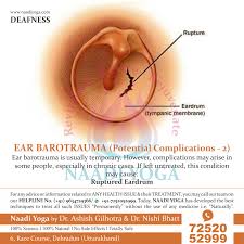 Image result for Inner Ear Decompression Sickness