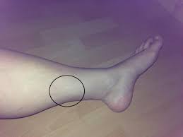 Auch so leichte schmerzen an verschiedenen stellen (selten an der bruchstelle selbst) sind da. Schmerzen Stechen Wade Innen Gesundheit Beine Waden