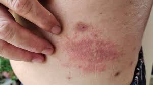 Image result for diaper dermatitis