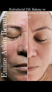 ✨Hydrafacial Cilt Bakımı ve benim, özel uyguladığım Facial masajı ✨,  _________________________________________________________, Detaylı bilgi ve  randevu için 📞 0543 191 08 09, Emine Aslan Beauty, ...