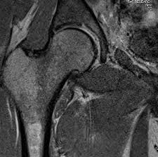 Image result for Hip Labral Tear