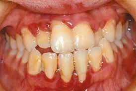 Dental Disease In Children With Chronic Illness Archives Of Disease In Childhood