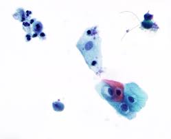 Image result for trichomonas images