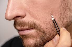 Are you plagued with ingrown hairs from shaving your face? Splintertweeze Ingrown Hair Wavy Hair Men Long Hair Beard