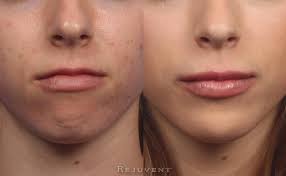 As with any injectable treatment, it is worth having consultations with a few doctors to find the person you feel most comfortable with and who has an aesthetic most similar to your goals. Non Surgical Chin Augmentation Photos Rejuvent Medical Spa Scottsdale