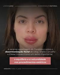 Você já ouviu falar sobre desarmonização facial? 😱 Recentemente, Gkay,  Sheila Carvalho e Eliezer compartilharam suas experiências de reverter os  procedimentos estéticos, e isso levantou uma grande questão: até onde o  excesso