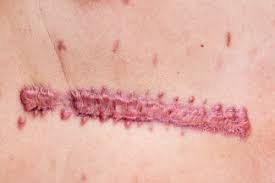 Once you get used to the controls, you. Topical Treatments In Management Of Raised Scars Woundsource
