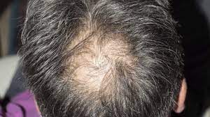 To test the relationship between substantial stress and hair loss, researchers artificially exposed mice to sound diffuse thinning. This Is How Stress Affects Hair Loss Youtube