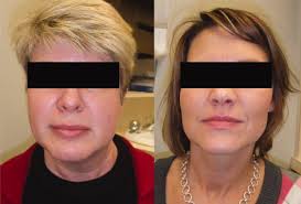 Adult cases of congenital muscular torticollis successfully treated with  botulinum toxin