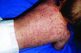 Does A Rash While On Antibiotics Mean An Allergy To That Drug Pulse Today