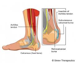 Achilles tendinopathy is divided into achilles tendonitis and tendinosis based on histopathological examination. Achilles Tendon Bursitis Information Sinew Therapeutics