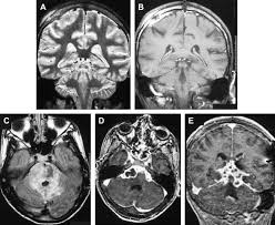 Serology for hsv showed positive hsv (1+2) igg and negative igm. Pin On White Matter Disease