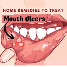 1 it's easy to confuse mouth ulcers with two conditions, so before you start any of these remedies, make sure you don't have: 11 Home Remedies For Mouth Ulcers In 2020 Home Remedies Natural Cure