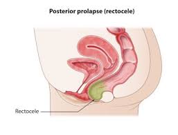 Image result for Rectal prolapse