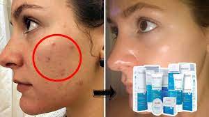 Urutan pemakaian skincare wardah lightening. Urutan Pemakaian Wardah Acnederm Series Paling Tepat Youtube