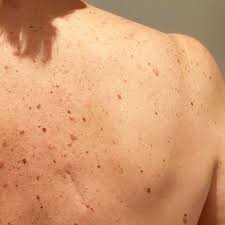 They stand for asymmetry, border, color and diameter. This Is What A Melanoma Scar Looks Like
