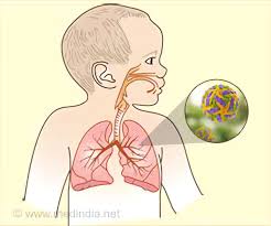 Rsv aiheuttaa infektioita yleensä talvikuukausina. Rsv Respiratory Syncytial Virus In Children