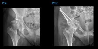 Periacetabular Osteotomy Pao Hip Surgery Hip Surgery Preparing For Surgery Surgery