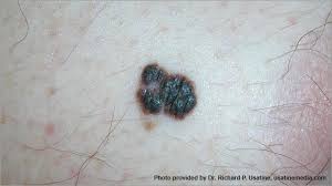 As the cancer grows, the size or shape of the visible skin mass may change and the cancer may grow into deeper layers of the skin. Skin Cancer Pictures Photos Pictures Of Skin Cancer