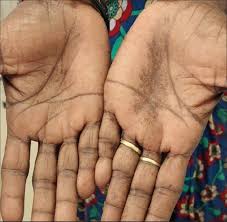 Image result for Diffuse Hyperpigmentation