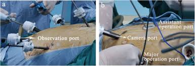 They were shocked, mckeown said of the gangsters when the raids went down, mostly in san jose and in north santa clara county and modesto and conducted by swat officers. Modified Reverse Puncture Anastomotic Technique Vs Traditional Technique For Total Minimally Invasive Ivor Lewis Esophagectomy World Journal Of Surgical Oncology Full Text