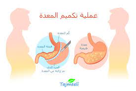 عملية تكميم المعدة التكلفة و التجارب و المخاطر تجميلي