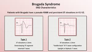 Brugada Syndrome