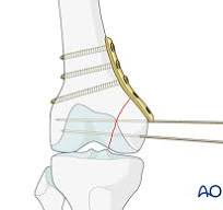 ORIF - Lag screws with or without buttress plate for Partial ...