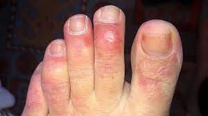 Does he like his job? Covid Toes Must Know Facts About The Strange Coronavirus Symptom Everyday Health
