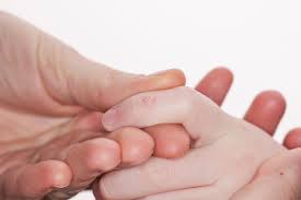 Pictures of warts on fingers. Photo Gallery Of Warts On Different Body Parts
