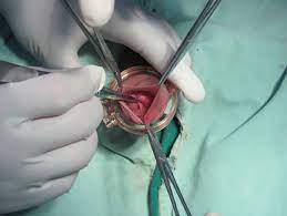Circumcision With No Flip Shang Ring And Dorsal Slit Methods For Adult Males A Single Centered Prospective Clinical Study Abstract Europe Pmc