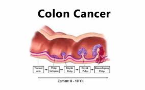 As the tumor grows, symptoms will depend on the location of the primary tumor within the intestine. What Is Colon Cancer Symptoms And Treatment Dr Ali Durmus